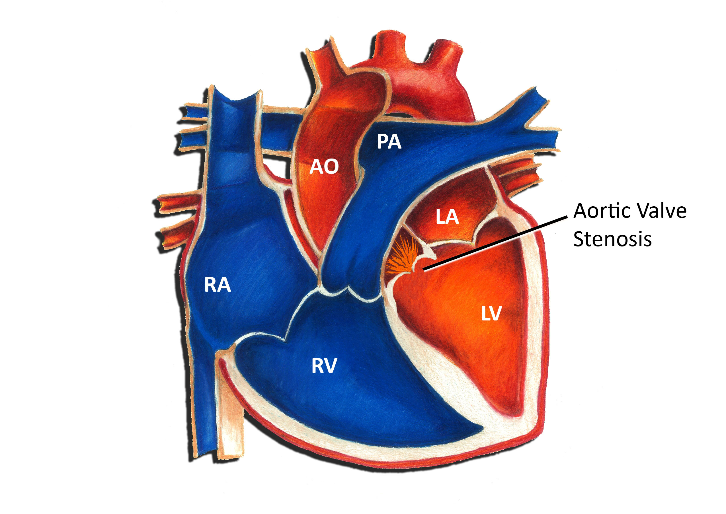 Aortic Valve Stenosis (AVS) And Congenital Defects American, 40% OFF