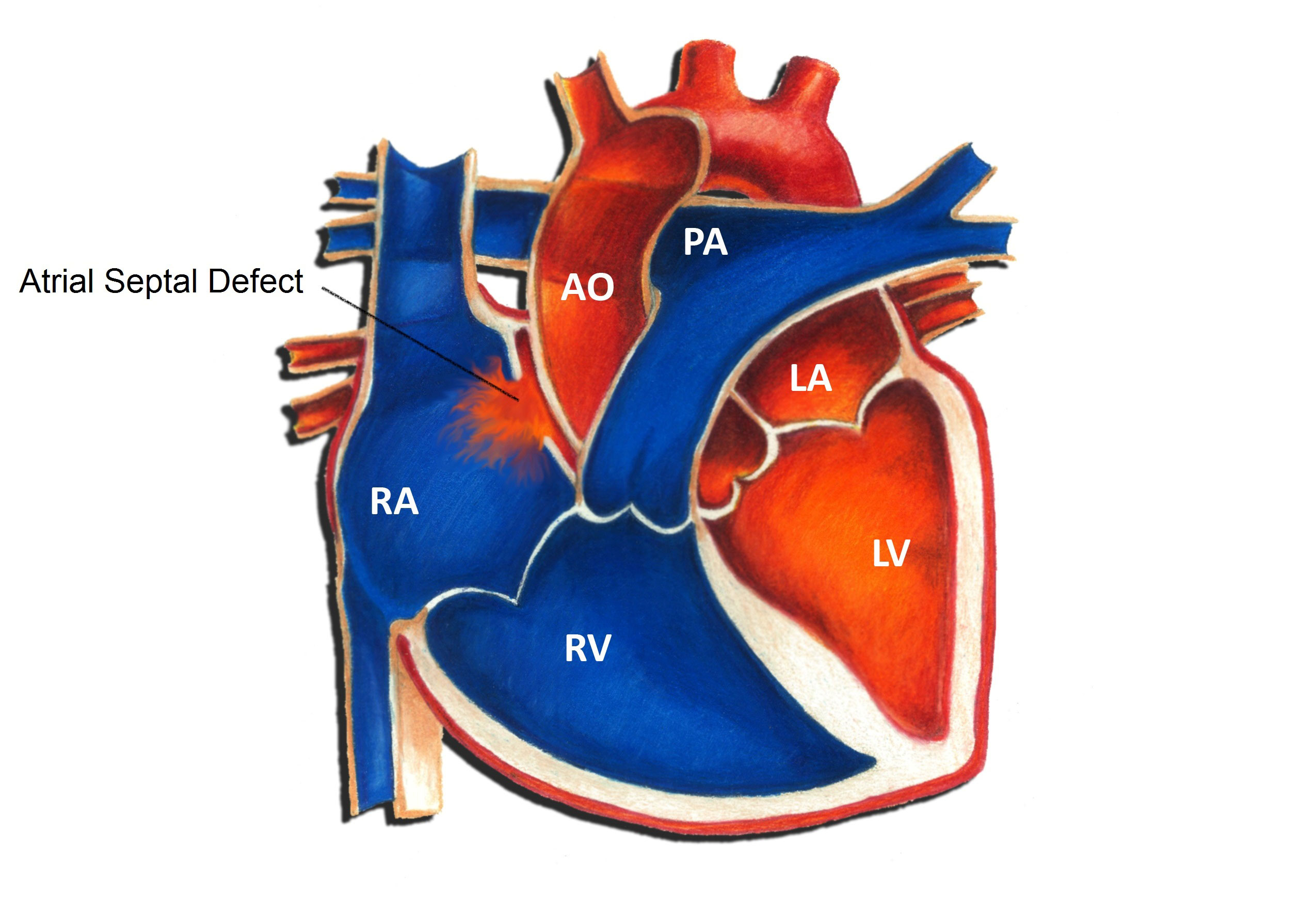 Atrial Septal Defect - Pediatric Heart Specialists