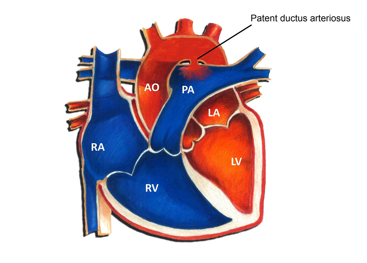 Patent Ductus Arteriosus Device Closure Pediatric Heart