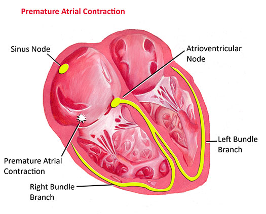 premature atrial contractions vs premature ventricular contractions