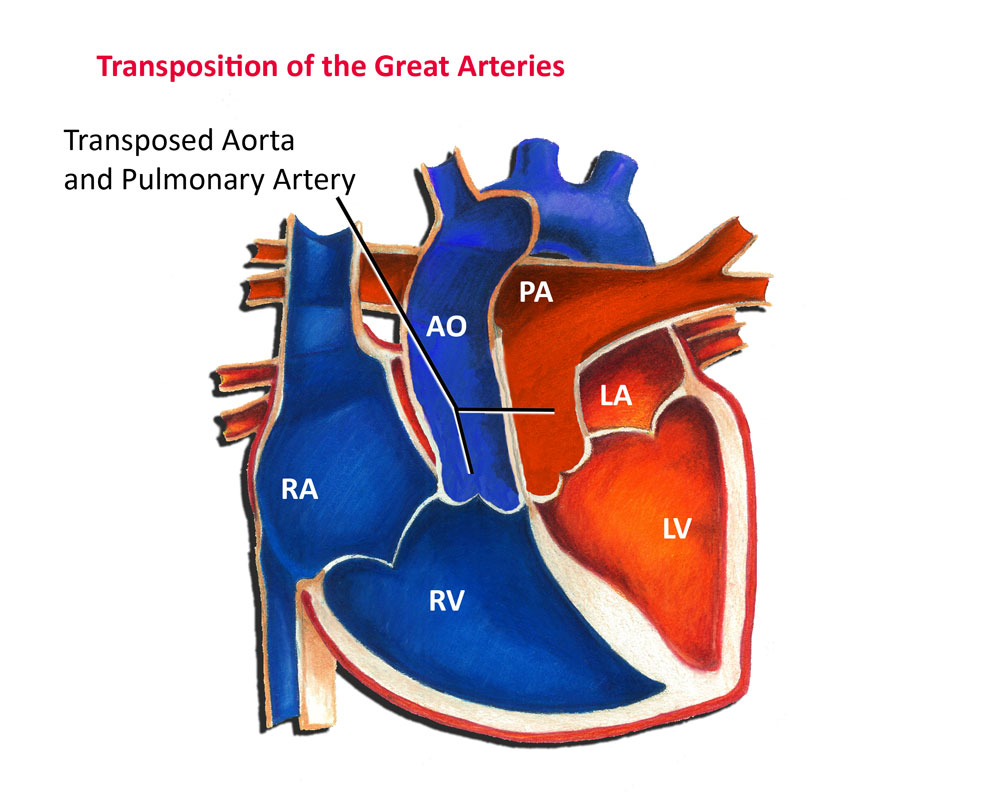 Transposition of the Great Arteries