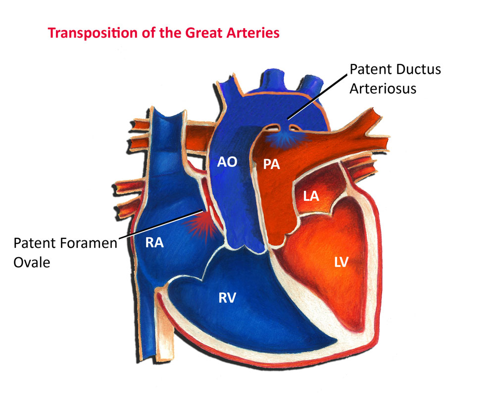 presentation transposition of great arteries