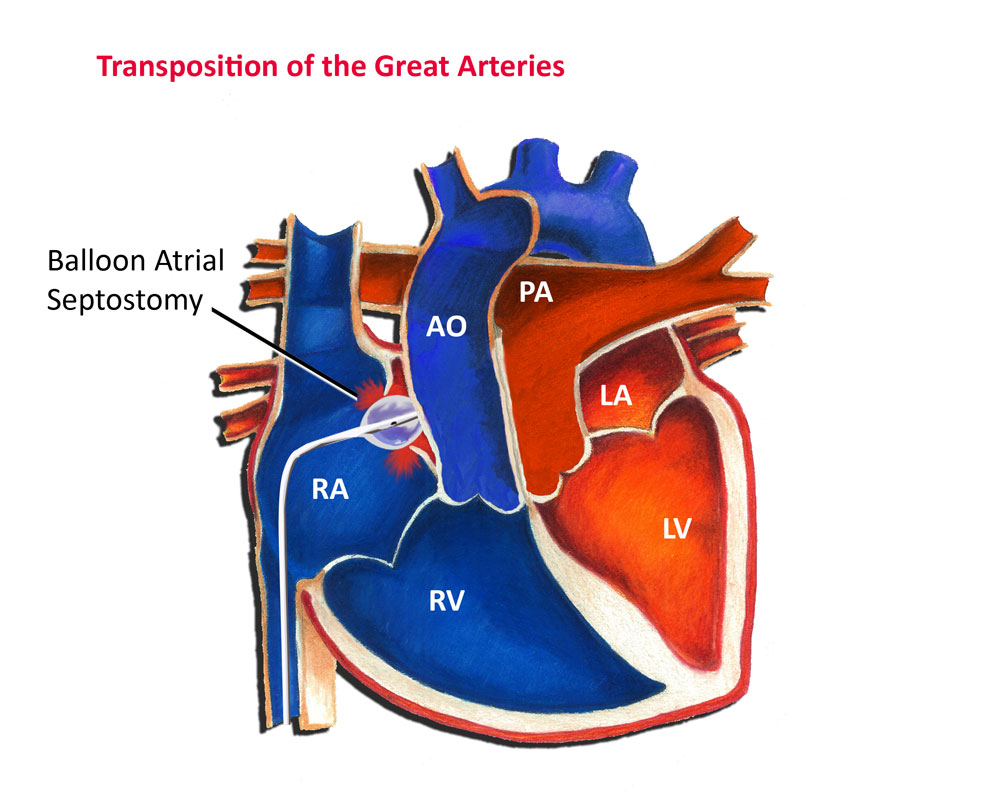 Balloon Atrial Septostomy