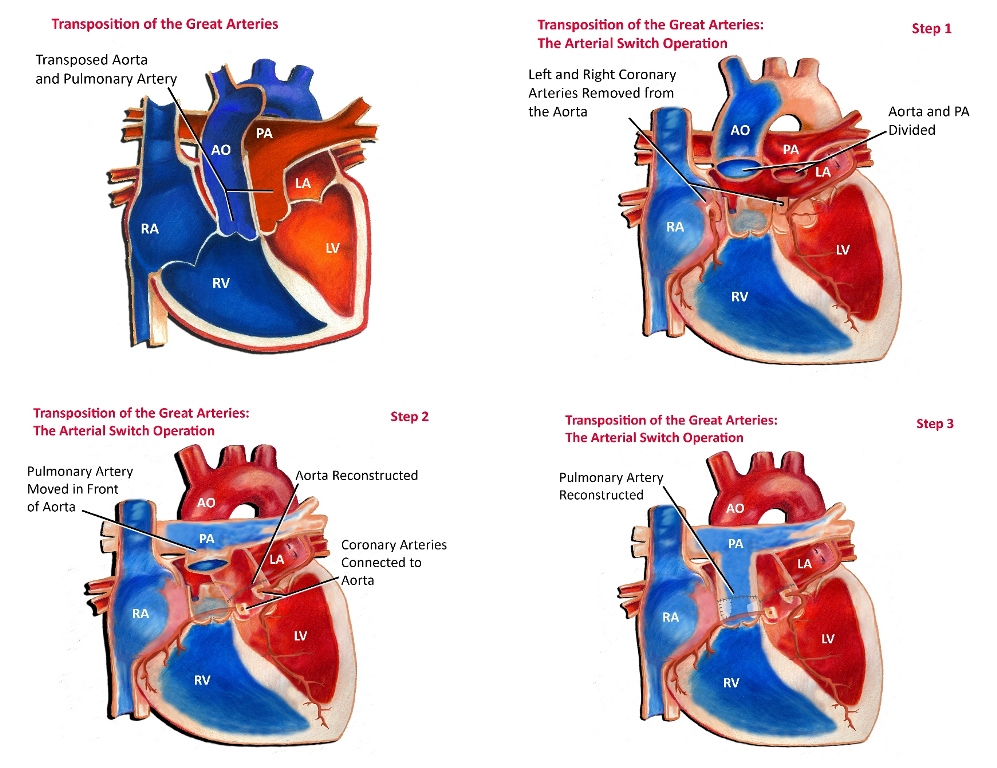 Arterial Switch Operation