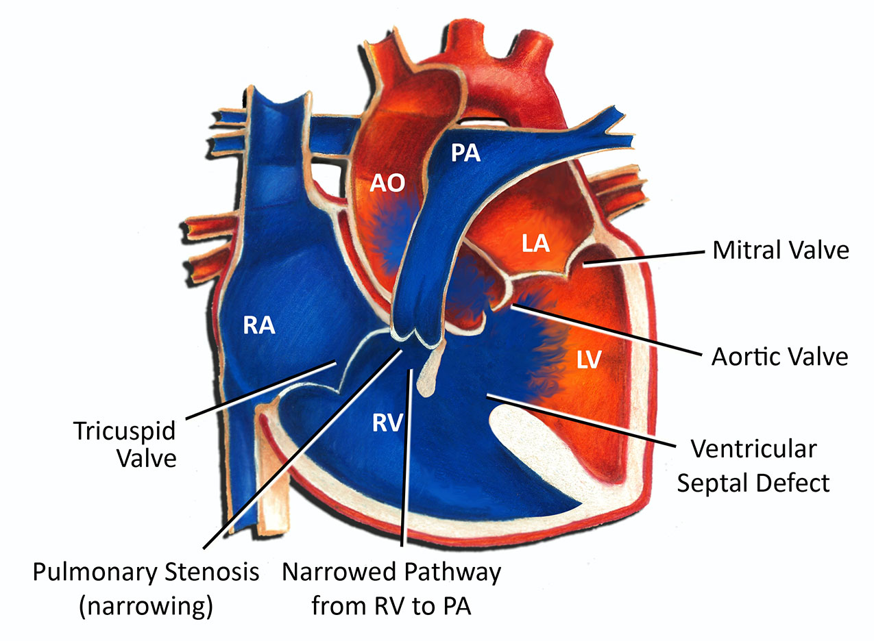 Tetralogy Of Fallot Pediatric Heart Specialists