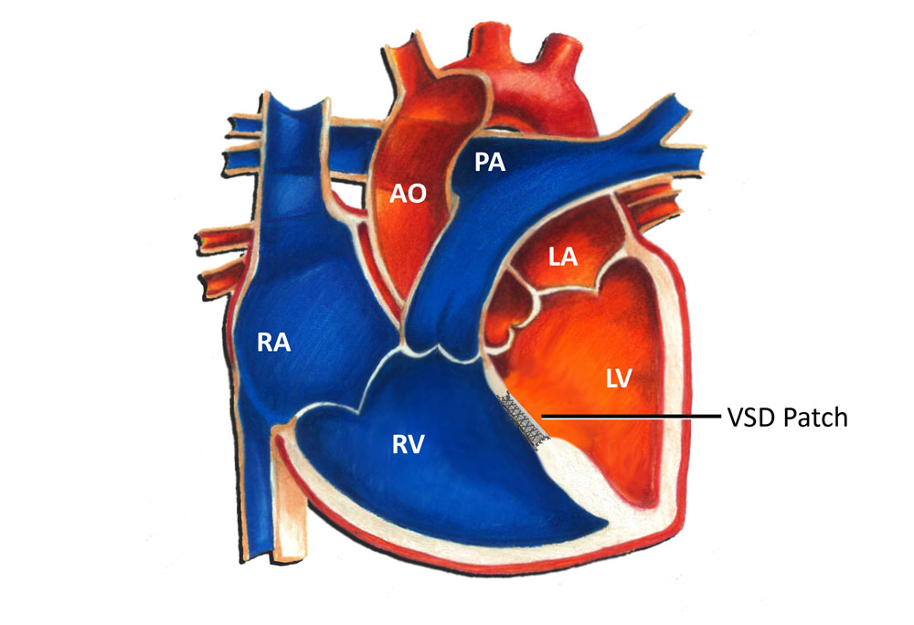 VSD surgery