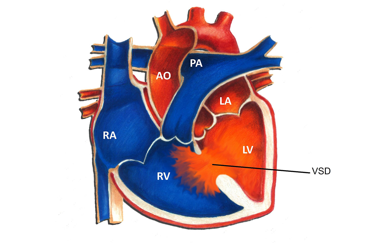 Ventricular Septal Defect (VSD) Pediatric Heart Specialists