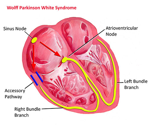 Wolff Parkinson White syndrome (WPW)