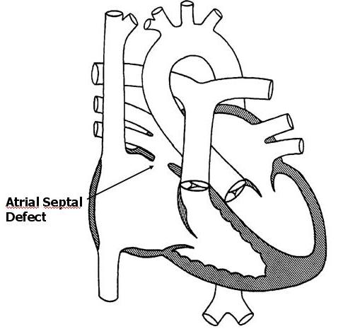 Atrial Septal Defect