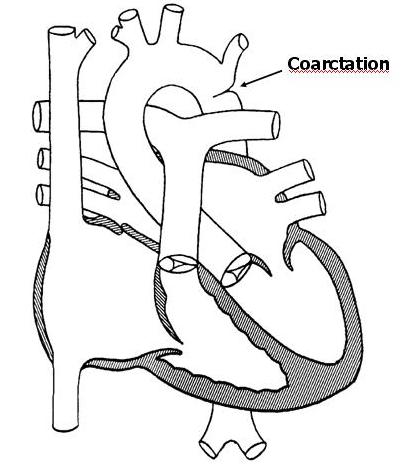 Coarctation of the Aorta