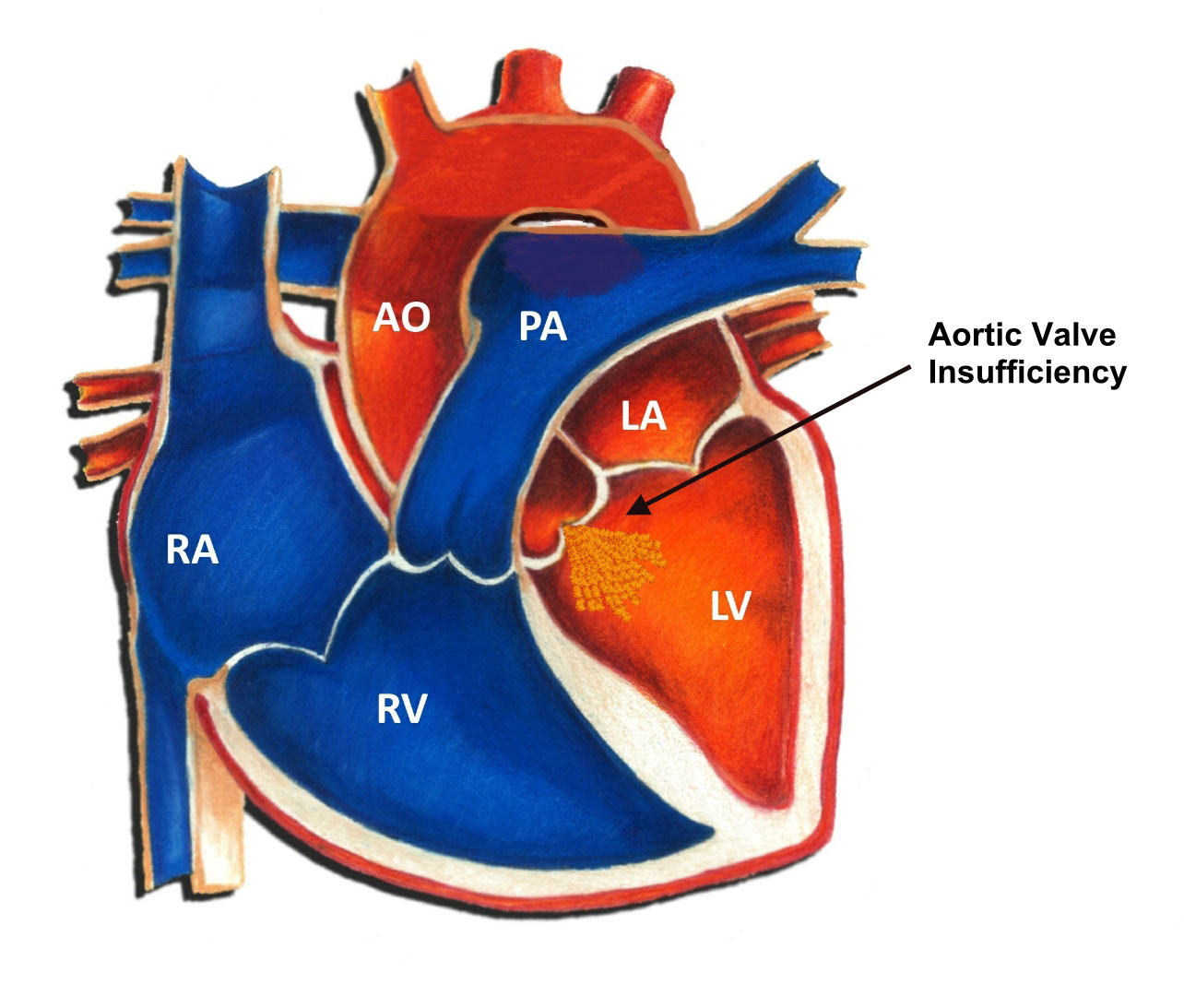 Aortic Valve Insufficiency