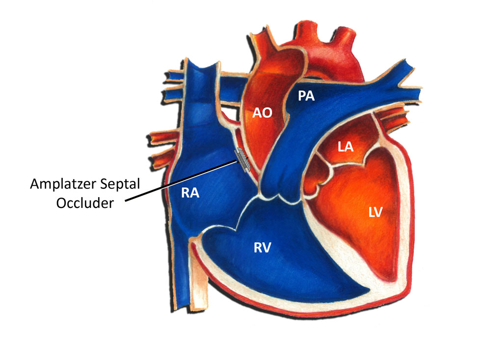 Amplatzer Septal Occluder