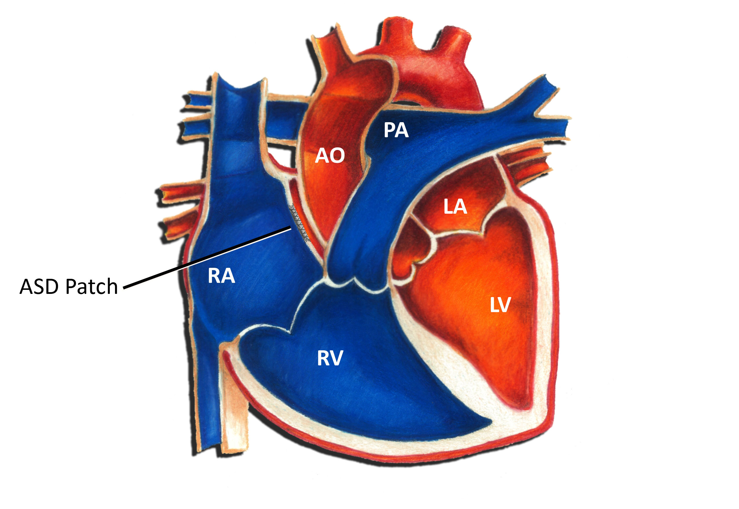 Atrial Septal Defect Surgical Repair