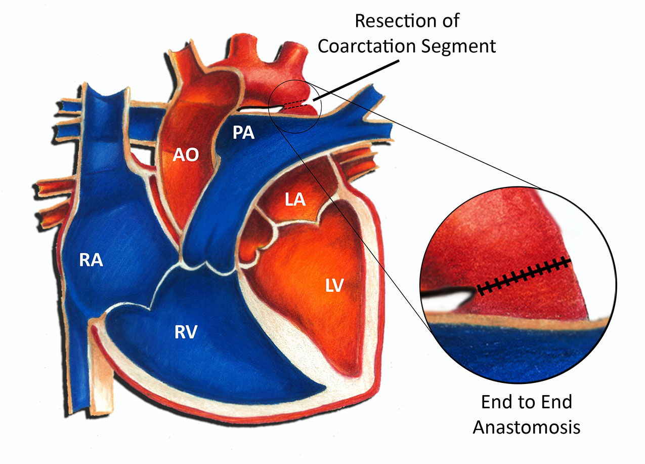 Coarctation of the Aorta Surgical Repair