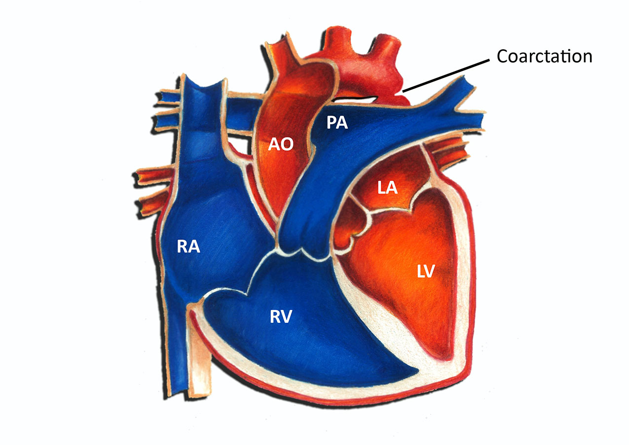 Coarctation of the Aorta