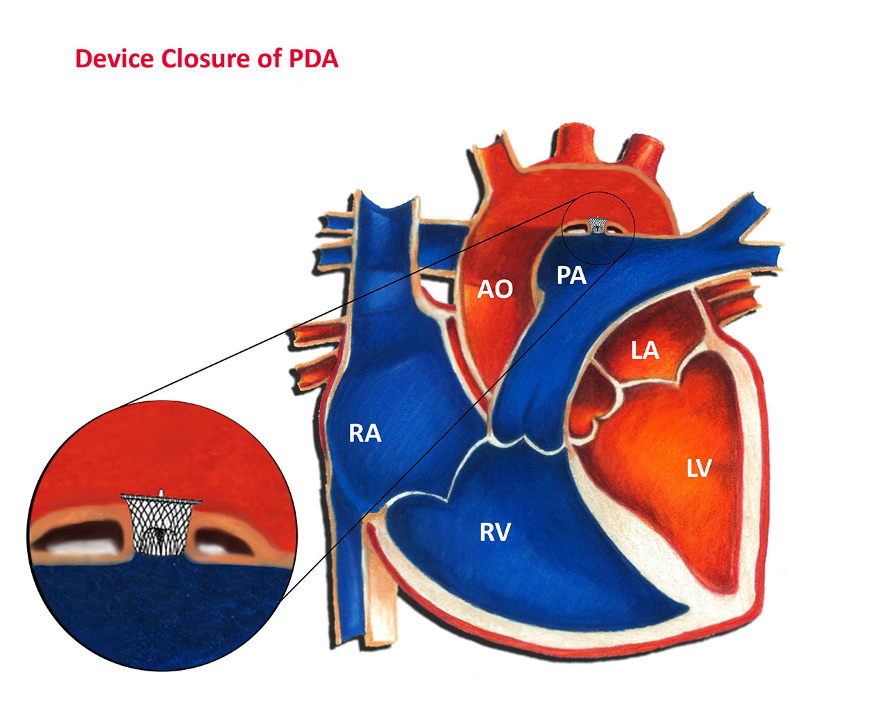 Patent Ductus Arteriosus Device Closure