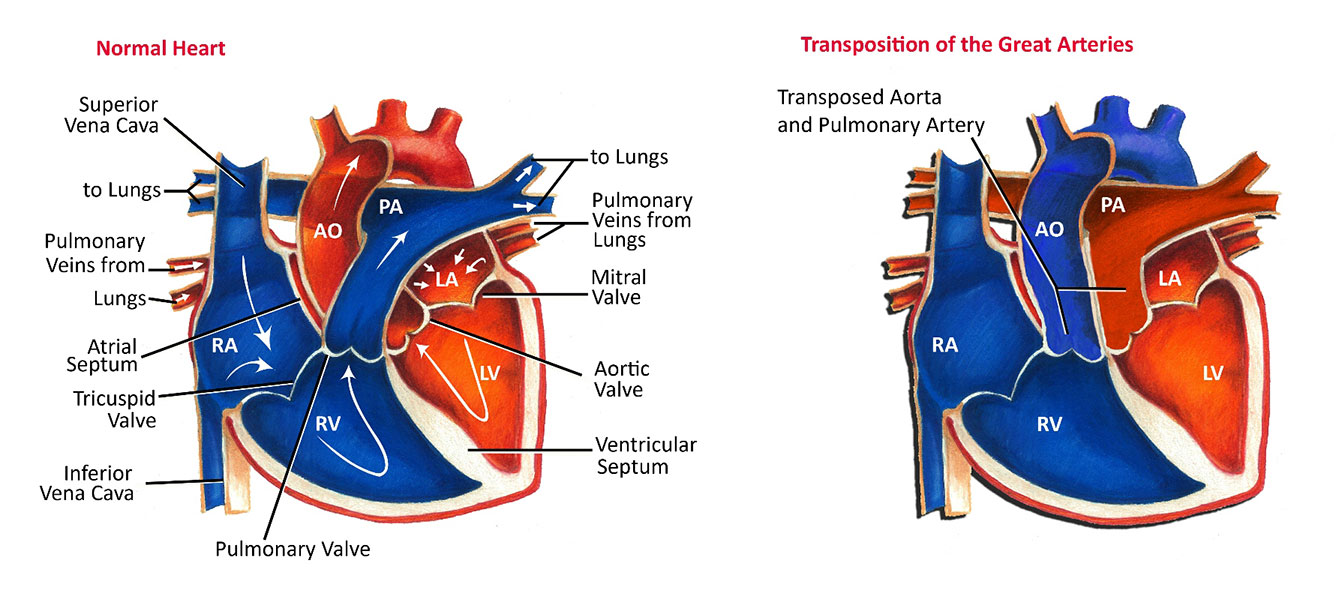 Transposition of the Great Arteries and Normal Heart
