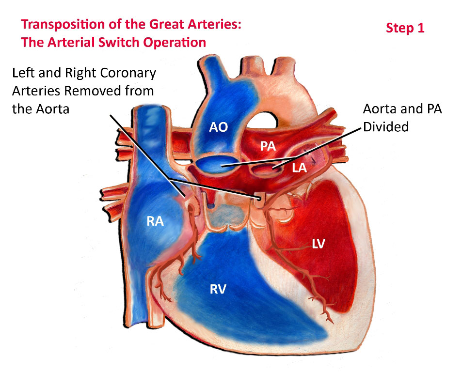 Arterial Switch Operation Step 1