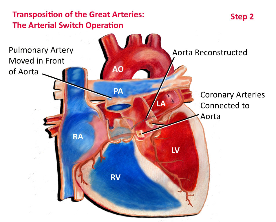 Arterial Switch Operation Step 2