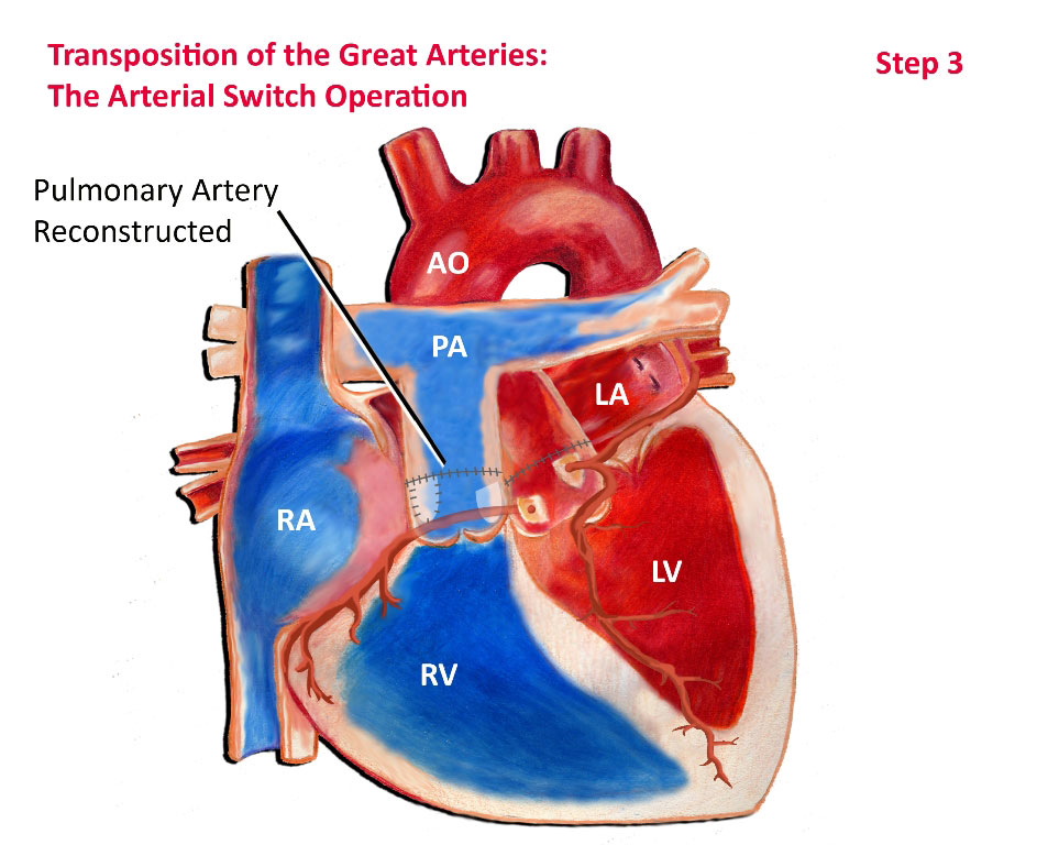 Arterial Switch Operation Step 3