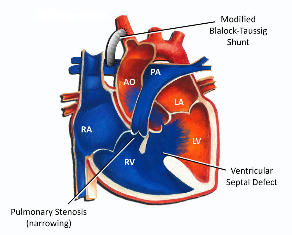 Tetralogy of Fallot Shunt