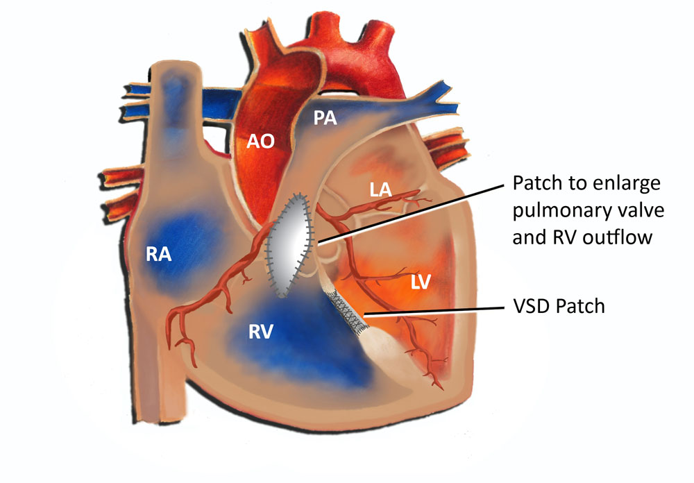Tetralogy of Fallot Surgical Repair