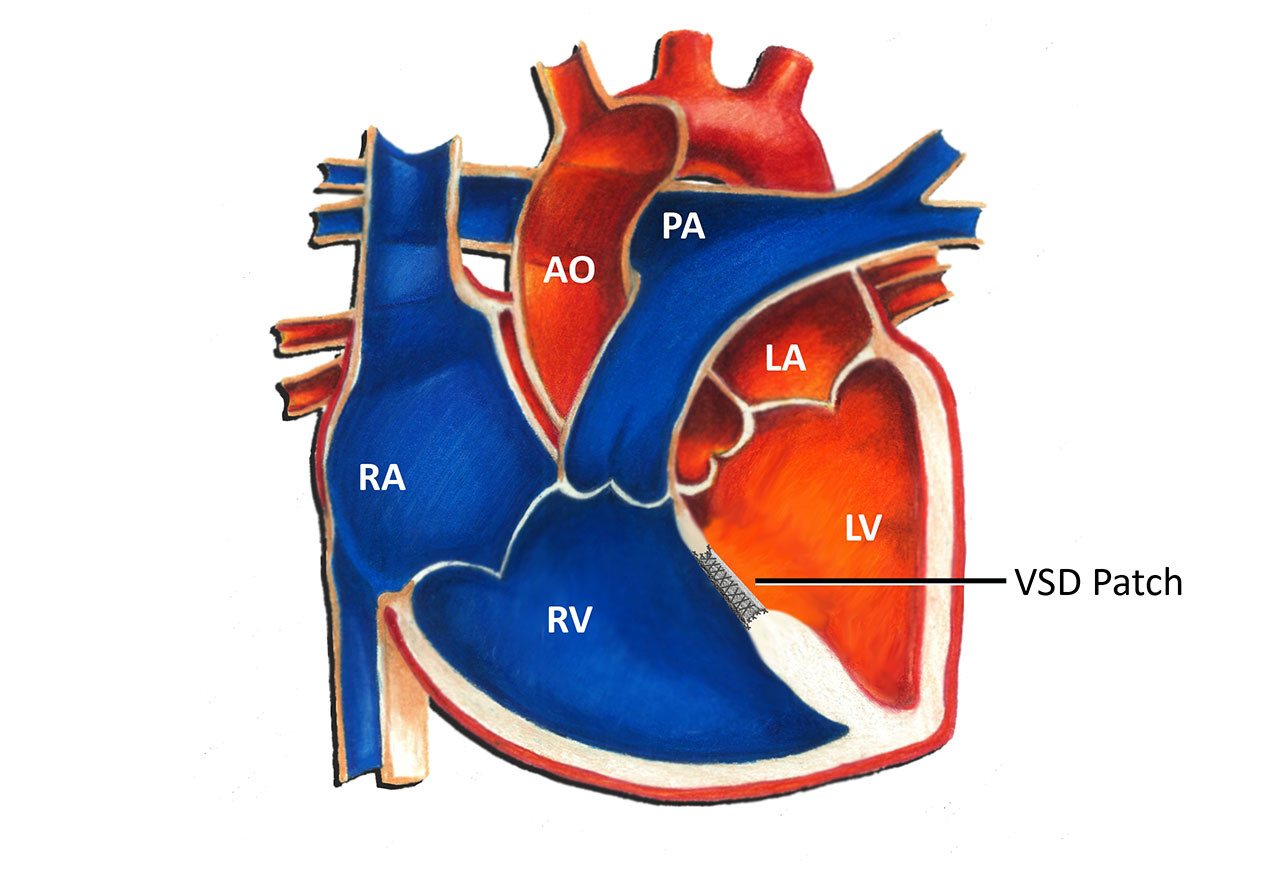 Ventricular Septal Defect Patch