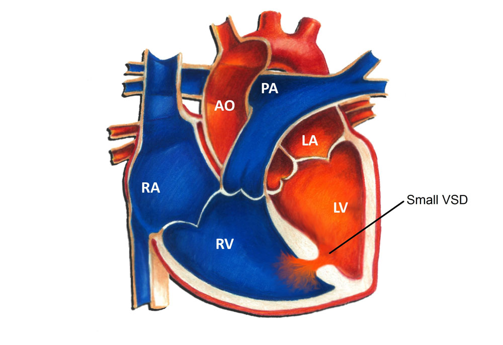 Small Ventricular Septal Defect (VSD)
