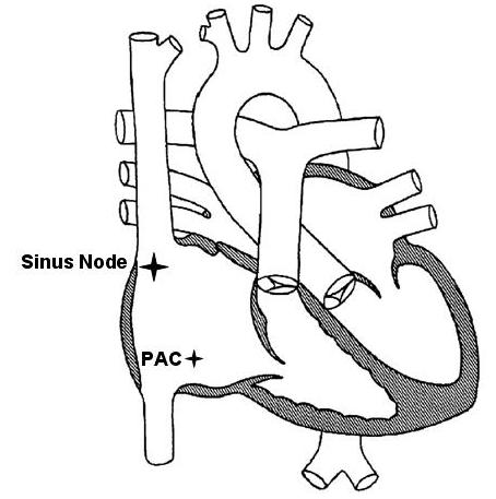 Premature Atrial Contractions