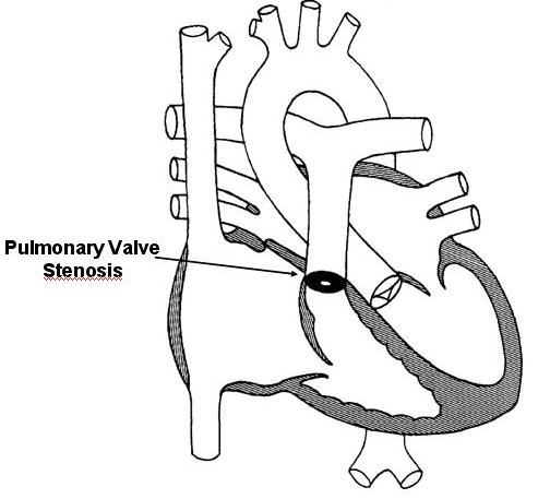 Pulmonary Valve Stenosis