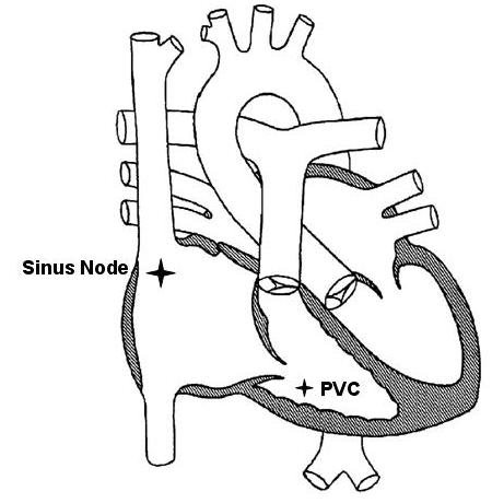 Premature Ventricular Contractions