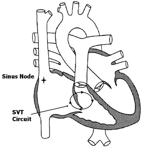 Supraventricular Tachycardia