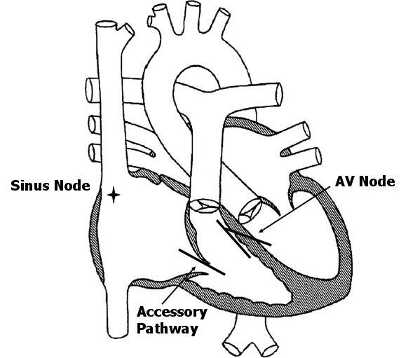 Wolff Parkinson White Syndrome